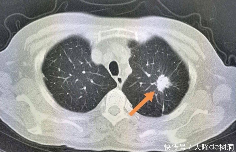 年年体检,为什么还得了晚期肺癌?体检有啥用!