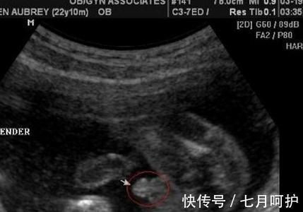 图像|B超看男女,最少只需要8周,开心一下下哦