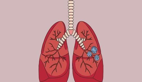  体质|结节体质的人，医生总结出几个“共性”，若你一个没有，值得庆幸