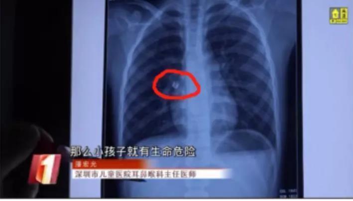 饰品|过生日毁了孩子一只手！家人反目：谁让你给娃送这个？