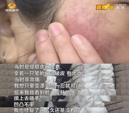 修复 女子花5000元祛斑后懊恼被“毁容”,工作人员:正常现象