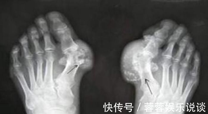 栀子苷|痛风尿酸不降,关节组织被“侵蚀”,5种植物泡水喝,尿酸悄悄走