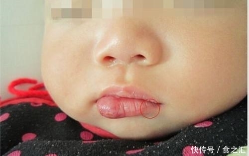 宝宝脸上是海绵状血管瘤吗?家长只要看是否出现这些症状