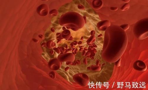 摄入量|高血脂患者，一日三餐照着吃，甘油三酯悄悄降，血脂平稳不升