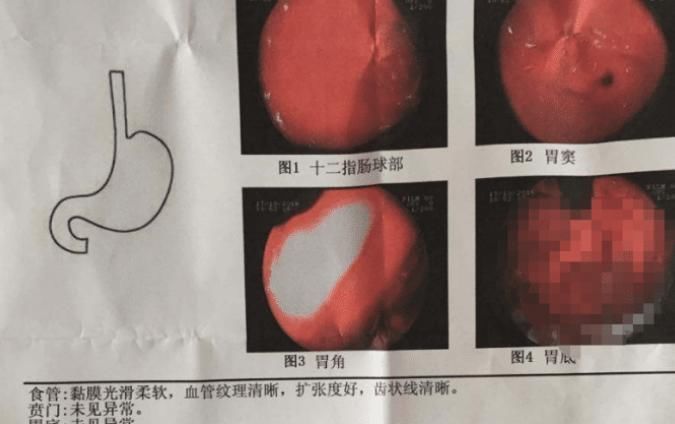 阿司匹林既能止痛，又能防血栓，但3类人不能长期吃，你未必知道