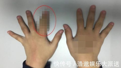 复发|得了这病,半岁宝宝脚趾比香蕉还粗!不注意还会复发…