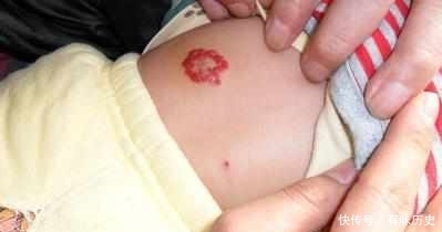 饭后立即|宝宝刚出生身上长了小红斑,婆婆不以为然,医生检查后我后悔莫及
