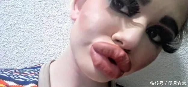 21次丰唇手术之后，这个妹子的嘴唇现在长这样…