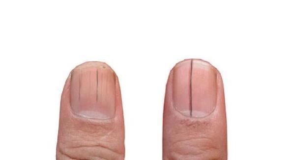 灰指甲|指甲上竖纹增多变黑怎么回事?可能是这4个问题,请自查一下!