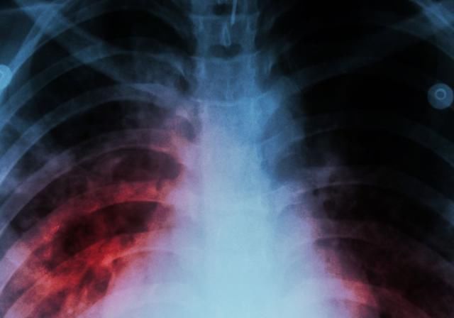 查出肺结节,担心是肺癌若是这2种情况,先放宽心