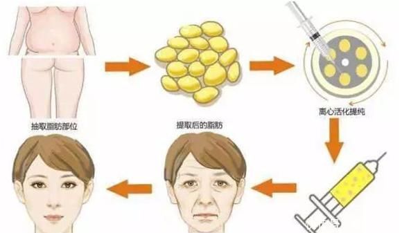 护理|面部脂肪填充能维持多久术后护理很重要