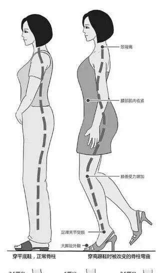 腰部肌肉 穿高跟鞋损伤颈腰椎美丽的代价到底有多大！
