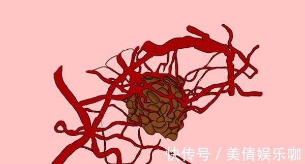 复发|80%癌症,在术后3年有复发风险,癌症复发时,身体有何提示?