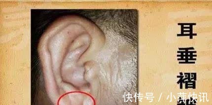 耳垂|血脂偏高的人,头部或有4个表现,若想调节血脂,给你2个小建议