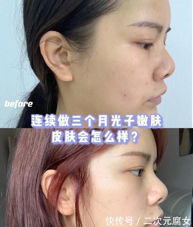 肤色 经常做光子嫩肤的人,皮肤后来怎么样了!