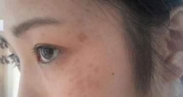 为什么女性脸上容易长斑点？找到原因了，3种办法让自己慢慢变美