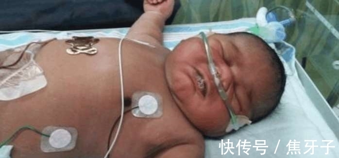 女孩|19岁女孩生下14斤巨婴,医生手术后也蒙圈了!