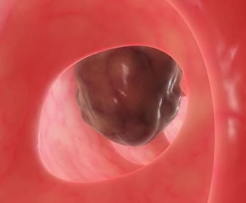 胆囊息肉|息肉一定会癌变吗提醒四种息肉拖不得，越早切除越好