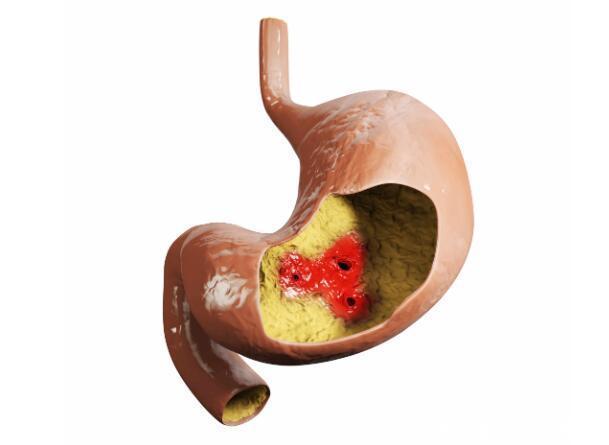 胃病|饭后胃部出现4种不适时,要及时检查,以免“拖”成胃病,别忽视