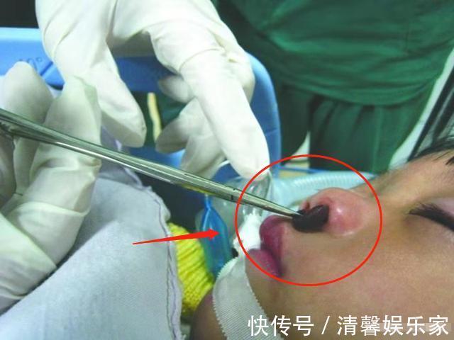 检查|4岁女孩常流鼻血,去医院检查却被送手术室,妈妈表示都怪我
