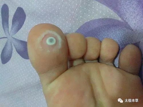 调匀|手脚出现的小毛病,用简易良方,原料易得,收藏吧·