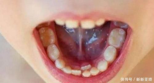 孩子“乳牙”脱落别着急扔,关键时刻能救命不懂为啥尽快了解下