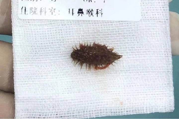 健康过春节|耳鼻咽喉头颈颅底外科:谨防食管异物及小儿气管异物