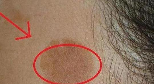 色斑处|老年斑越长越多?教你祛斑方法,任意学会一种,老年斑会慢慢消失