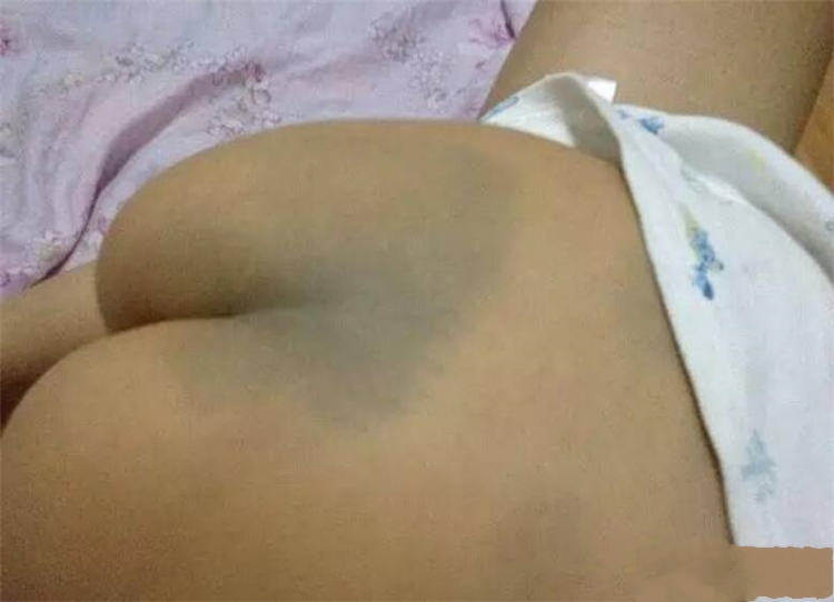 新生儿|胎记是怎么来的,有人说是被阎王爷打答案可能不是你所想的