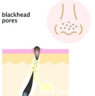 泡沫|看到黑头就想挤担心越挤越多!网上3种方法才损伤皮肤,要避开