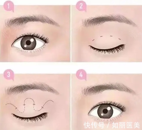 纱布 割双眼皮的注意事项有哪些?做好这些注意事项,术后效果倍棒!