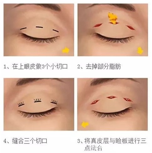 创伤 双眼皮手术方式:埋线、全切、韩式三点怎么选?你的手术方式选对了吗?