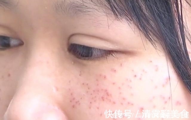 祛斑|本想花20块理发,却被忽悠贷款1万做祛斑,结果脸变“马蜂窝”