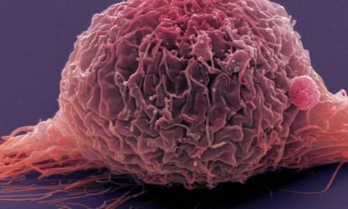 老大哥|65岁男士无痛血尿就诊,医生庆幸:警惕性高,及时发现了早期癌症