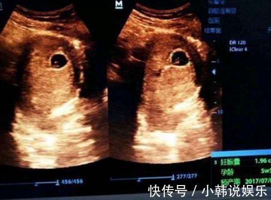 股骨长|B超单上的3个“数据”,真幸运,可能怀了个“小棉袄”即将驾到