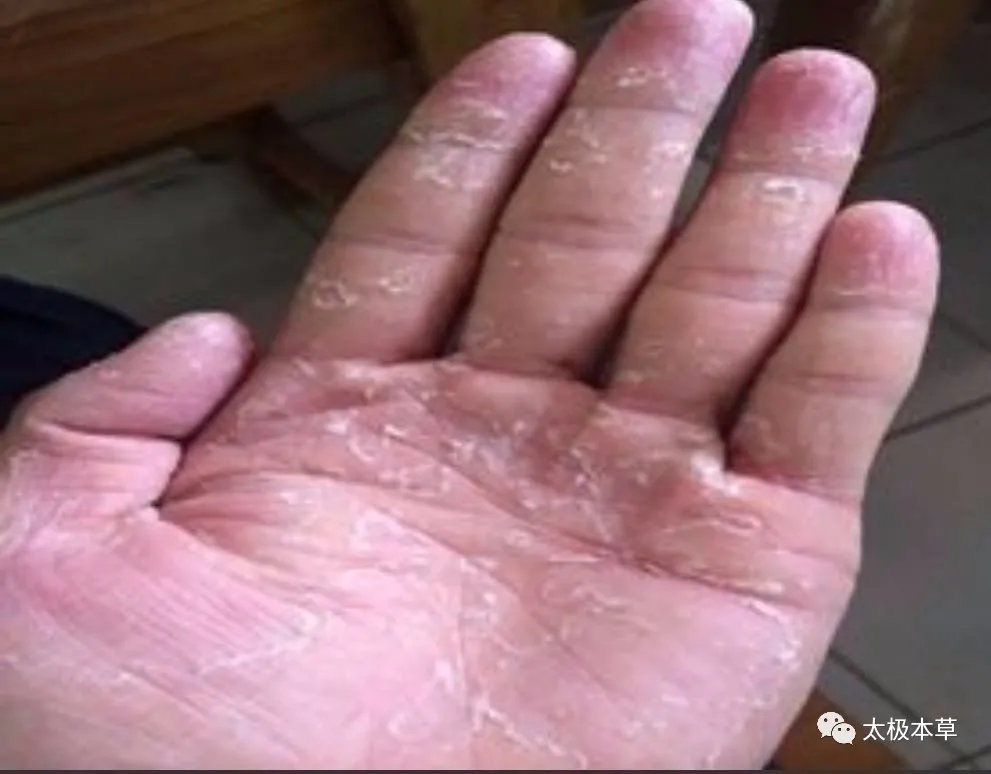 调匀|手脚出现的小毛病,用简易良方,原料易得,收藏吧·