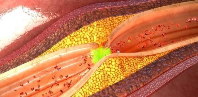 血管堵塞|血管不好，少碰二红，多吃二黑，牢记四句话，血管会越来越好