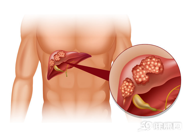 乳腺癌|不瞒你说：最难治愈的癌症中，这5种“榜上有名”