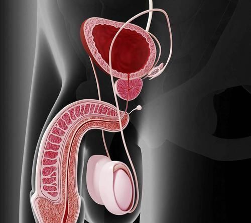 前列腺钙化|什么是前列腺钙化？专家详解前列腺钙化4大危害