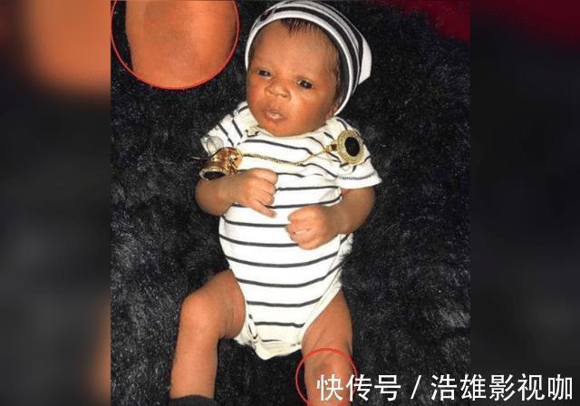 宝宝|最美胎记!双胞胎姐姐“消失”在腹中,化为胎记印在弟弟腿上