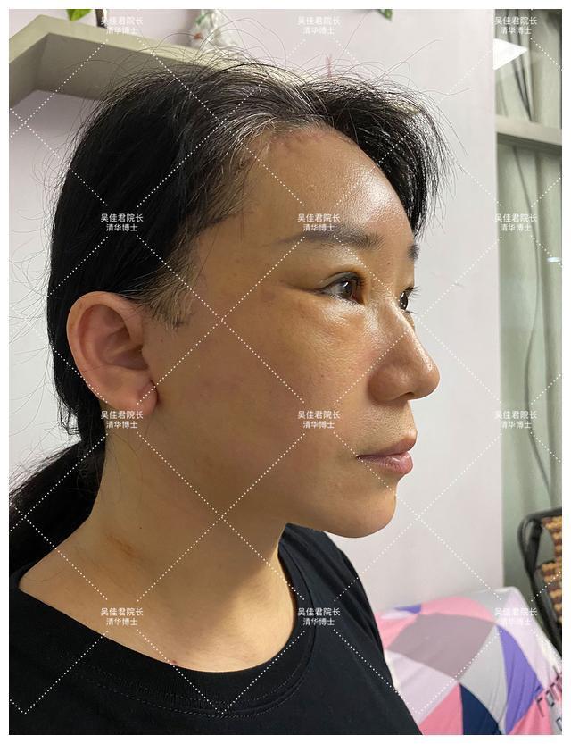 面部 51岁小拉皮术后1个月,我想跟大家说点真心话