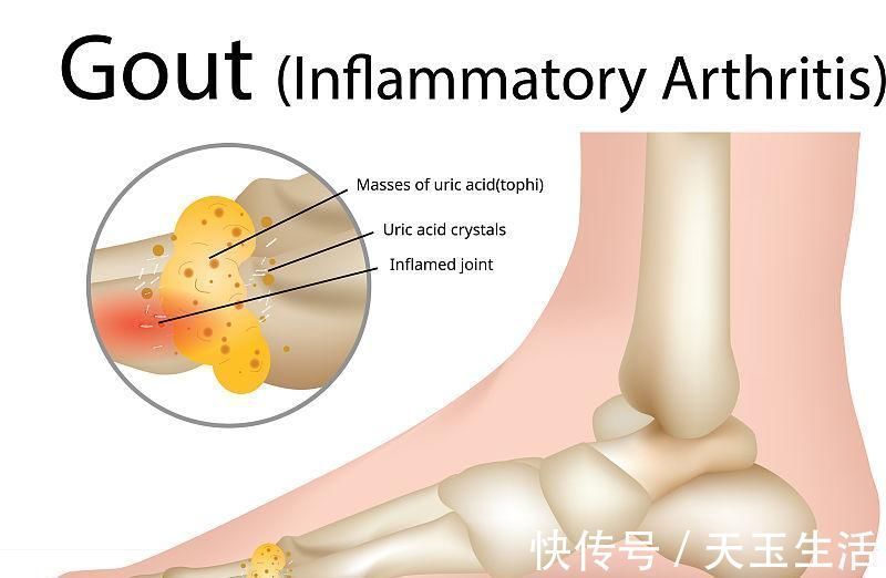痛风患者|真正降尿酸的四个秘诀，多喝水排在第二位，排在首位的你很少坚持
