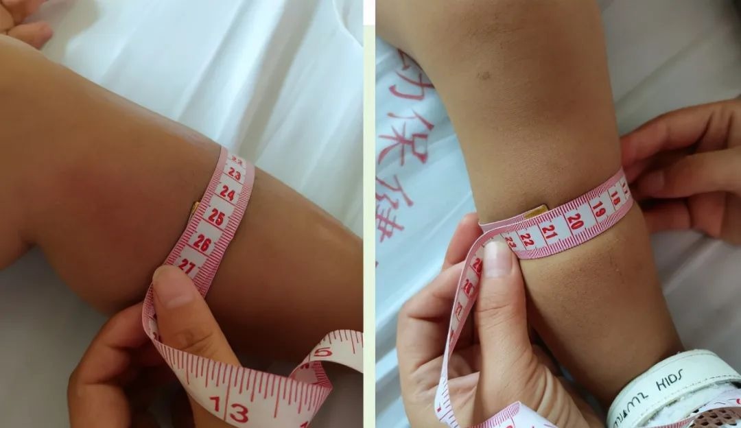 医生|被蚊子咬了一口,孕妈紧急剖宫产保命!1岁宝宝也中招!医生紧急提醒……