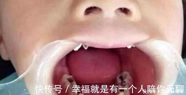 牙齿|3岁儿子满口“小黑牙”,罪魁祸首不是糖果,而是父母的无知