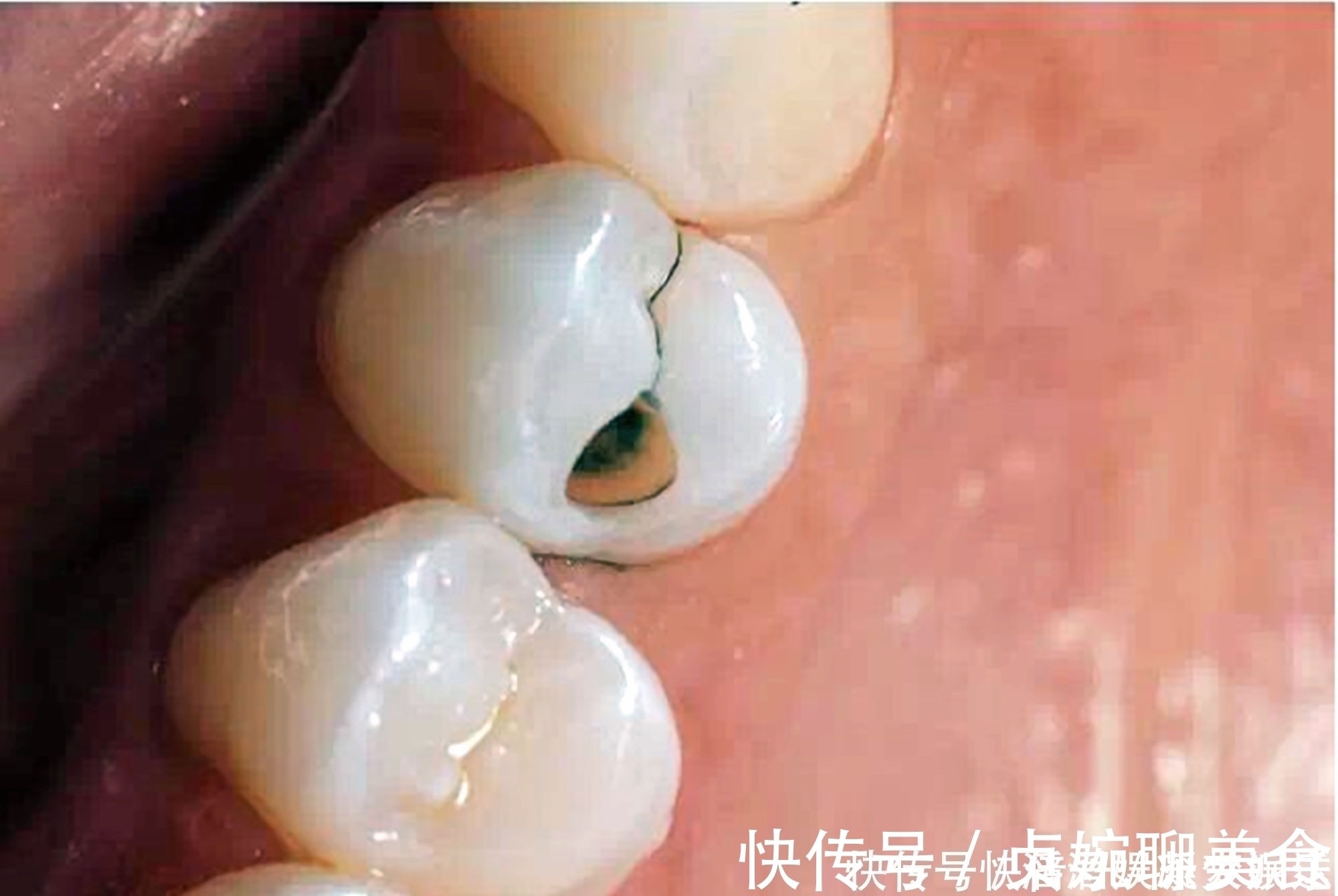 父母|好不容易等到宝宝换牙期,新牙却长歪了医生家长无知惹得锅