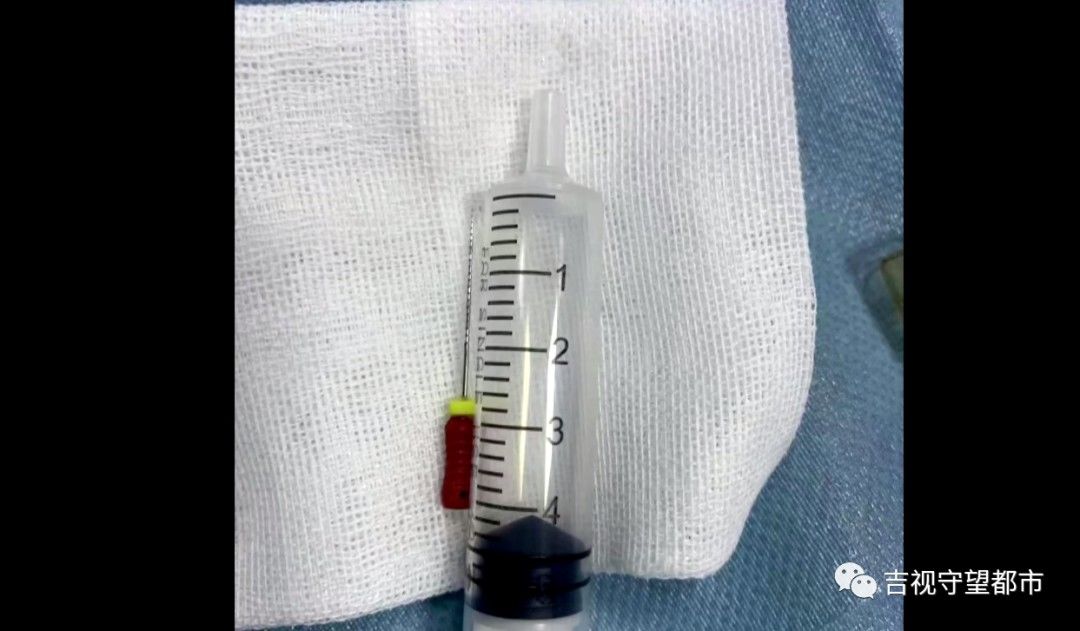 消化道|牙修一半针没了！胃内发现修牙针...