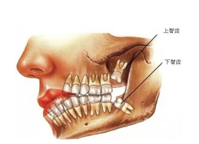 智齿|【科普健康】智齿一定要拔吗？出现这种情况，请及时拔掉智齿