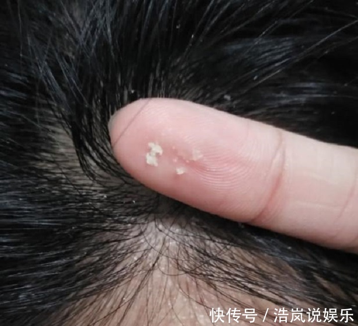 颗粒|头皮上抠下“白色颗粒物”一般逃不过这“3点原因”,别忽视