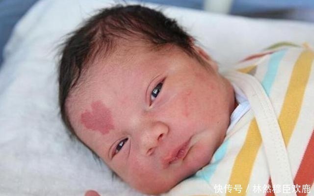 小鸿儿|胎记咋来的产科医生除了遗传,还与孕期的这3种行为有关