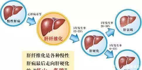  肝硬化|49岁乙肝患者，一直坚持抗病毒治疗仍然查出肝硬化